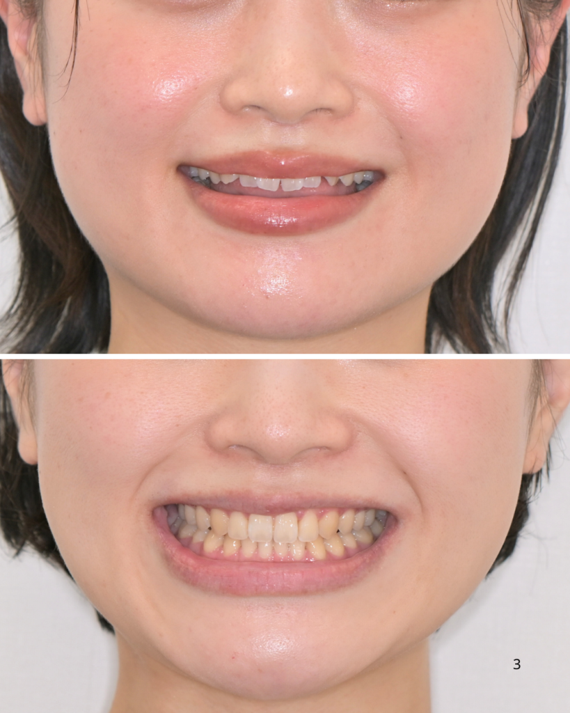 開咬 マウスピース矯正 治療後