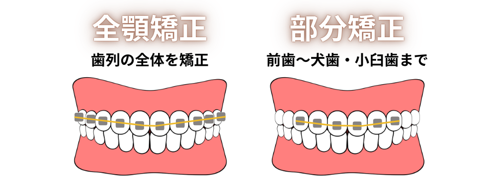 全顎矯正（全体矯正）：歯列全体を動かす
部分矯正：歯列の一部分だけを動かす