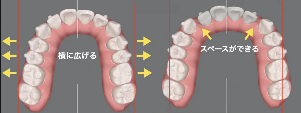 ④側方拡大・前方拡大：歯列を前や横に拡大する