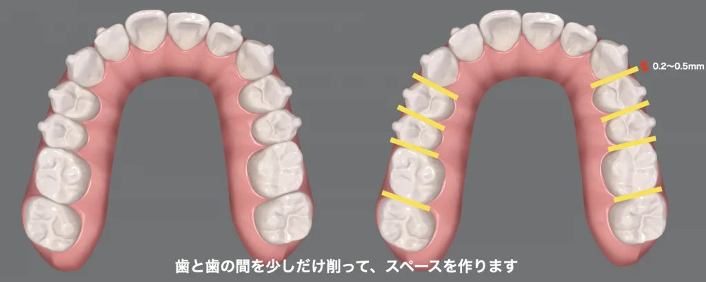 ②IPR：歯を削って歯の横幅を小さくする