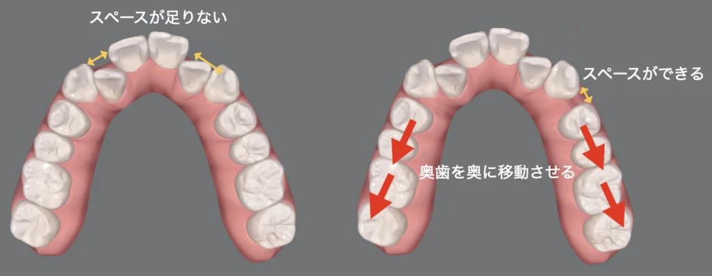 ③遠心移動：歯列を後方に引っ込める