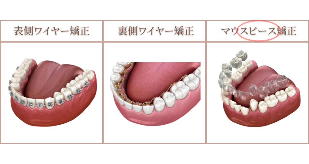 八重歯の治療：マウスピース矯正（インビザライン）