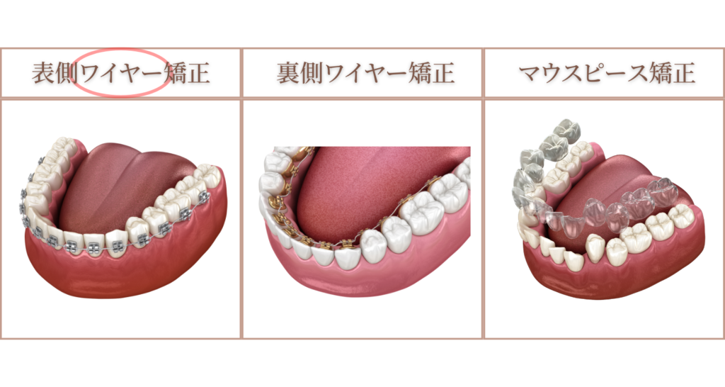 八重歯の治療：表側ワイヤー矯正