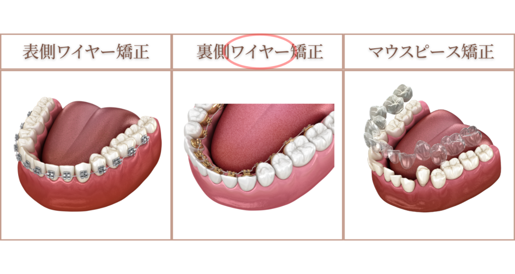 八重歯の治療：裏側ワイヤー矯正