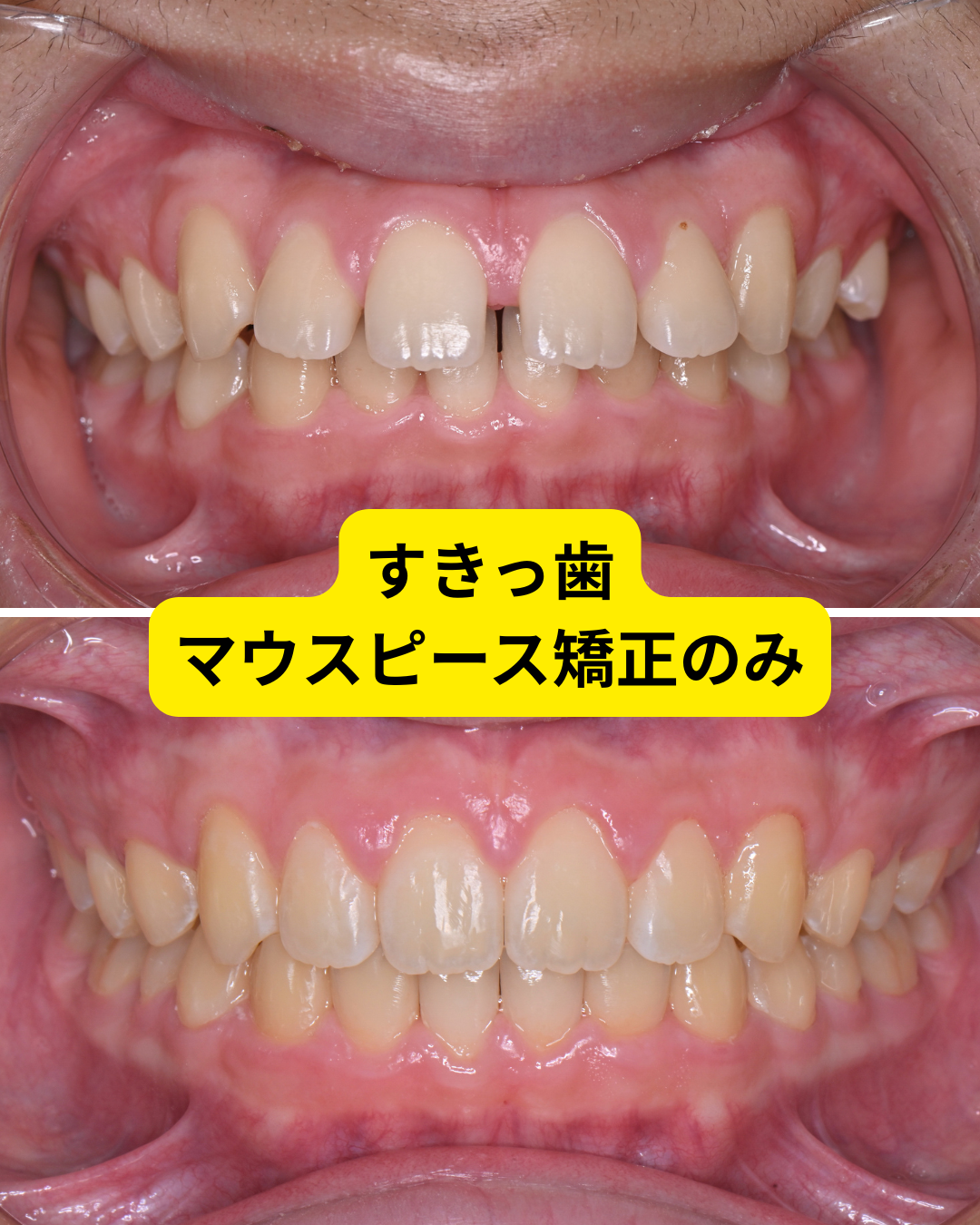 すき っ 歯 矯正
