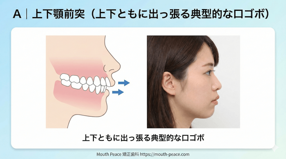 A｜上下顎前突（上下ともに出っ張る典型的な口ゴボ）