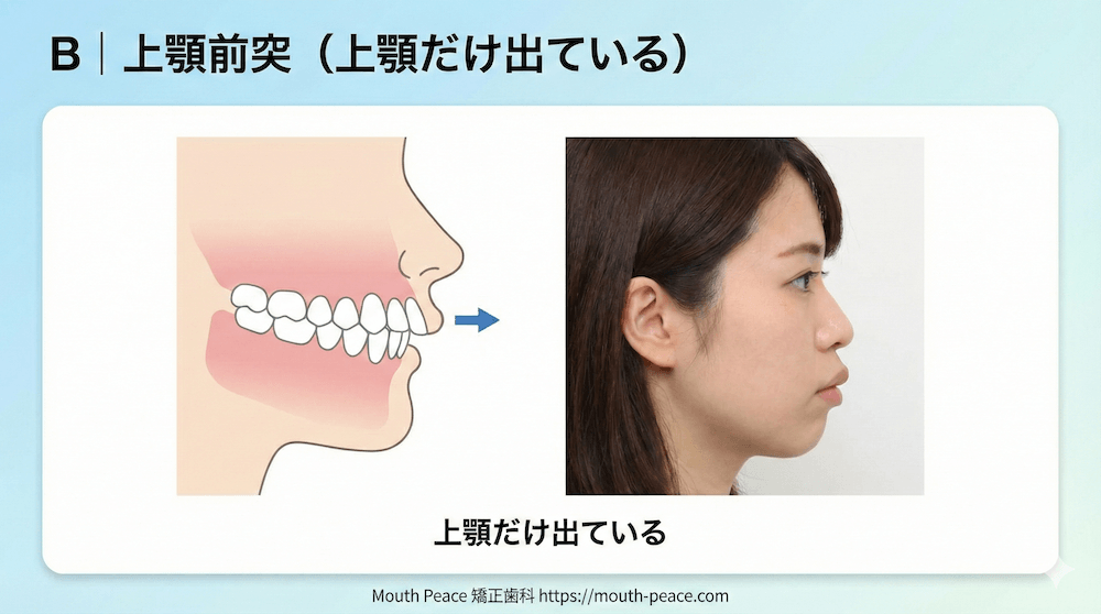 B｜上顎前突（上顎だけ出ている）