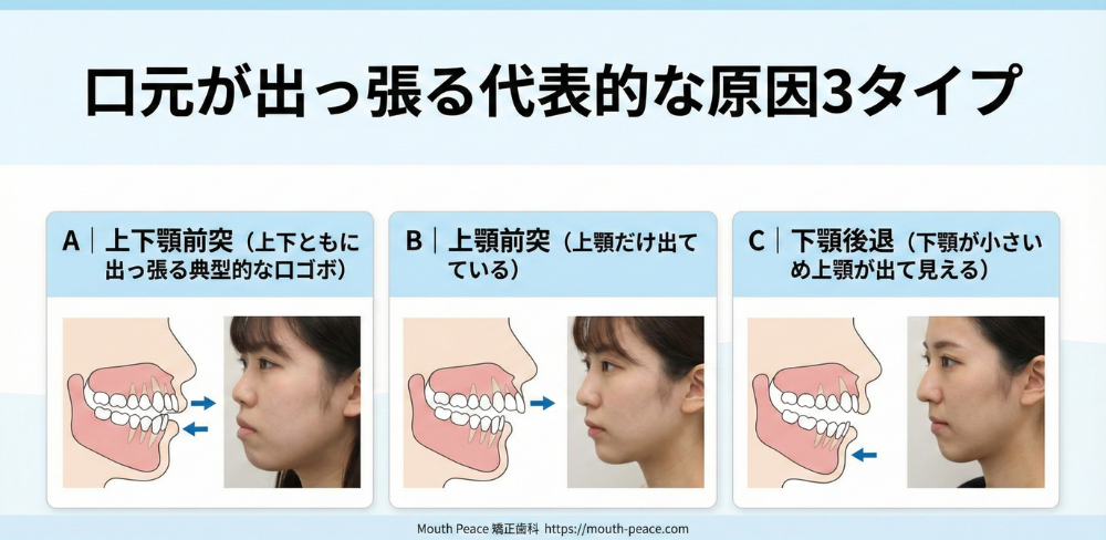 口元が出っ張る代表的な原因3タイプ