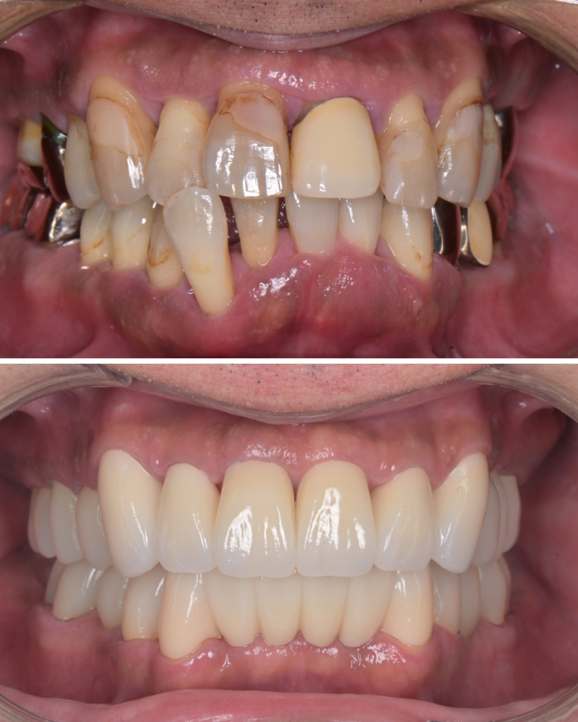 50代 歯周病 歯がグラグラ セラミック治療 ビフォーアフター