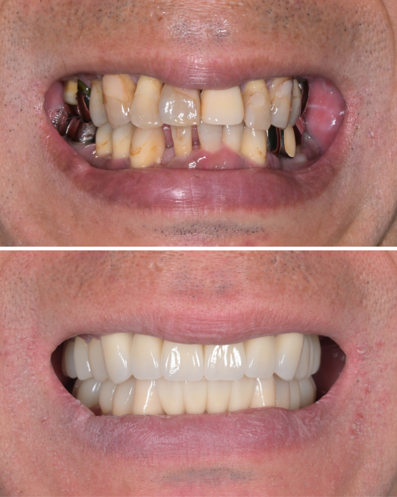 50代 歯周病 歯がグラグラ　セラミック治療 ビフォーアフター
