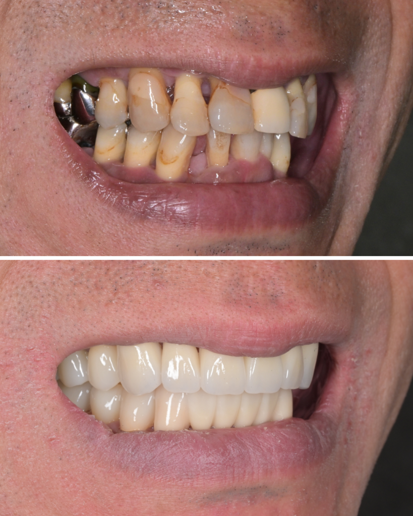 50代 歯周病  歯がグラグラ　セラミック治療 ビフォーアフター
