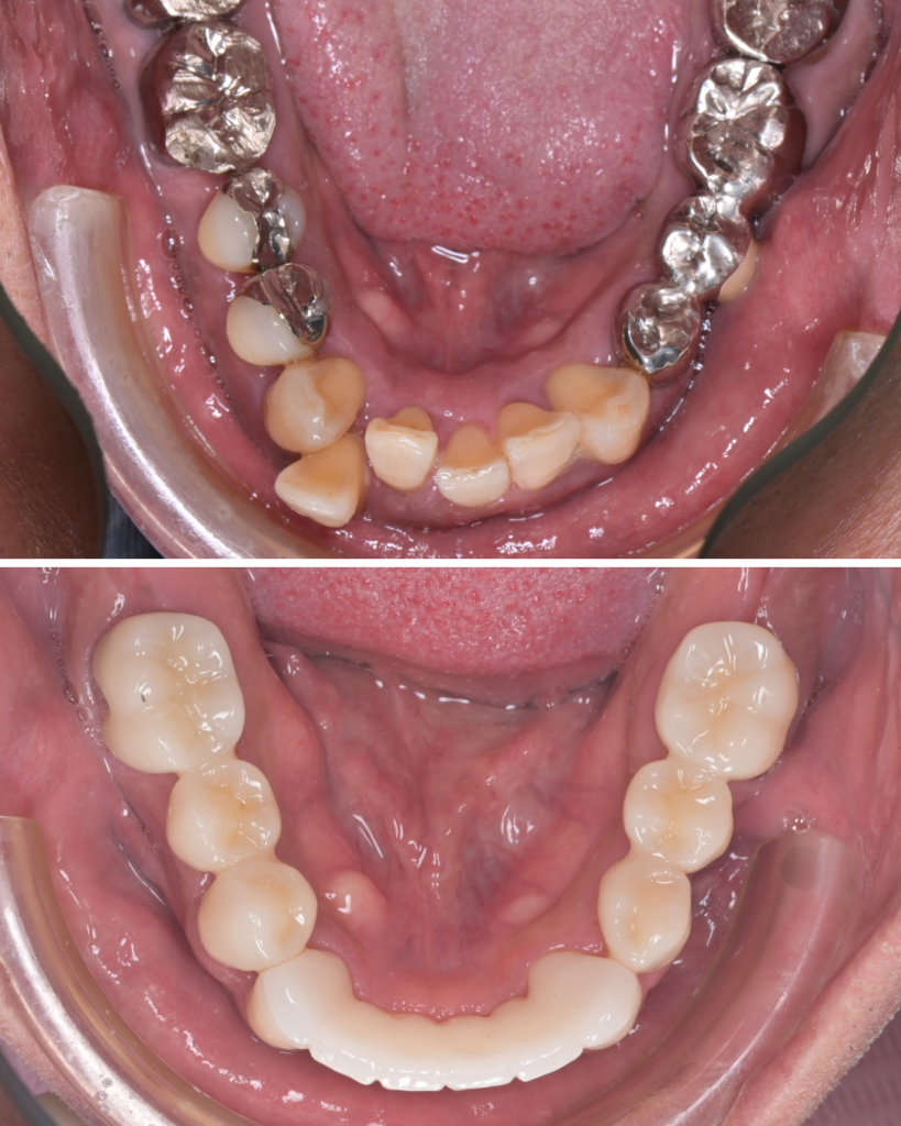 50代 歯周病  歯がグラグラ　セラミック治療 ビフォーアフター