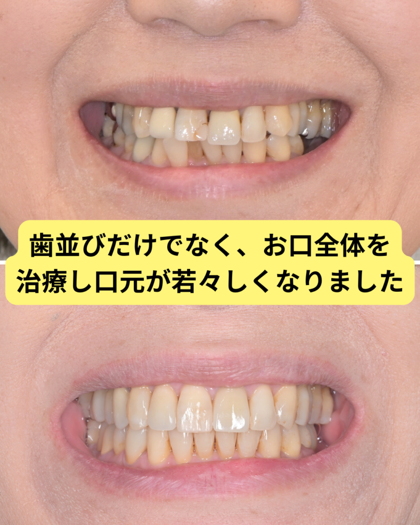 60代の歯列矯正のビフォーアフターの写真