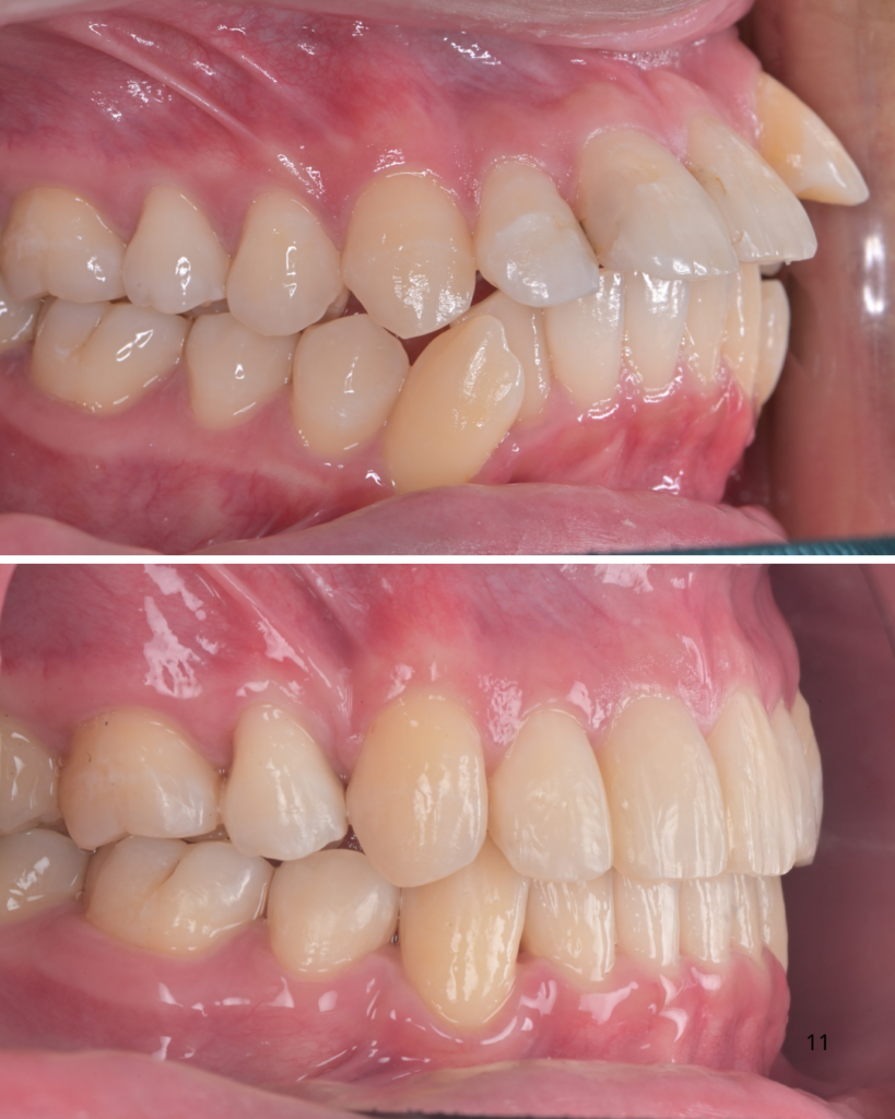 出っ歯の歯列矯正ビフォーアフター（マウスピース矯正）
