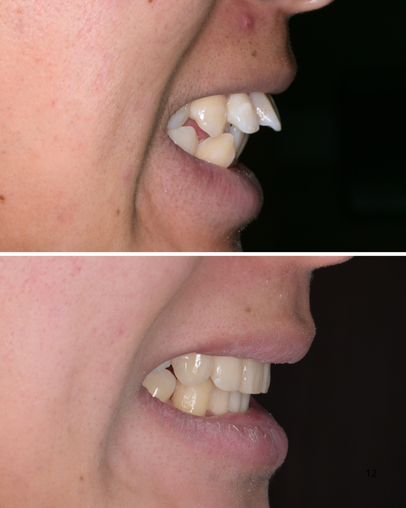 出っ歯改善による口元変化の比較写真
