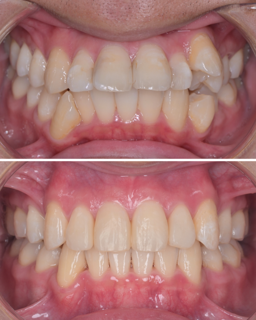 出っ歯の歯列矯正ビフォーアフター（マウスピース矯正）
