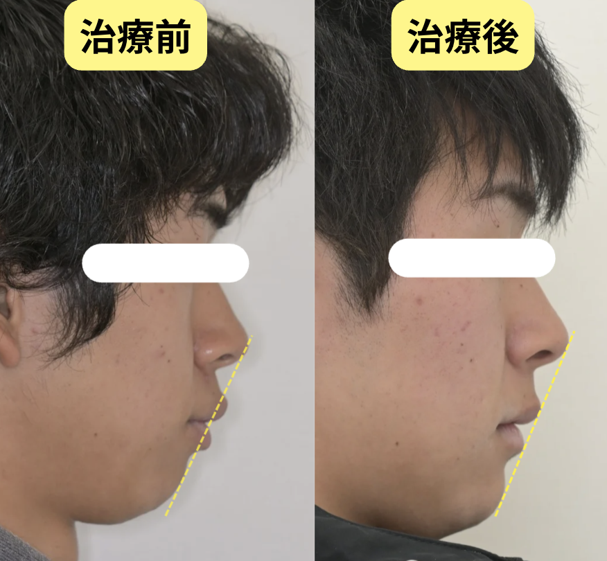 出っ歯の抜歯矯正マウスピース治療のビフォーアフター横顔比較
