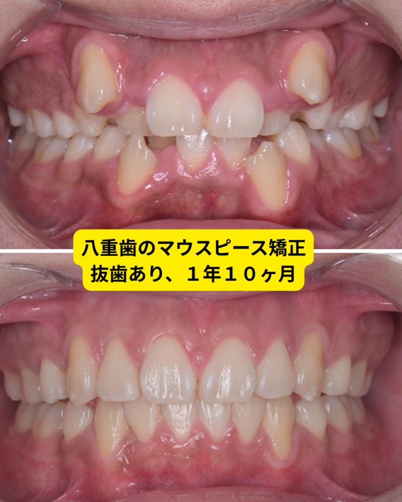 八重歯のマウスピース矯正の治療前後