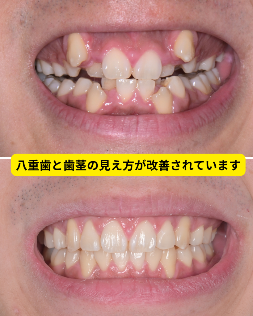 八重歯のマウスピース矯正ビフォーアフター ガミースマイル改善後