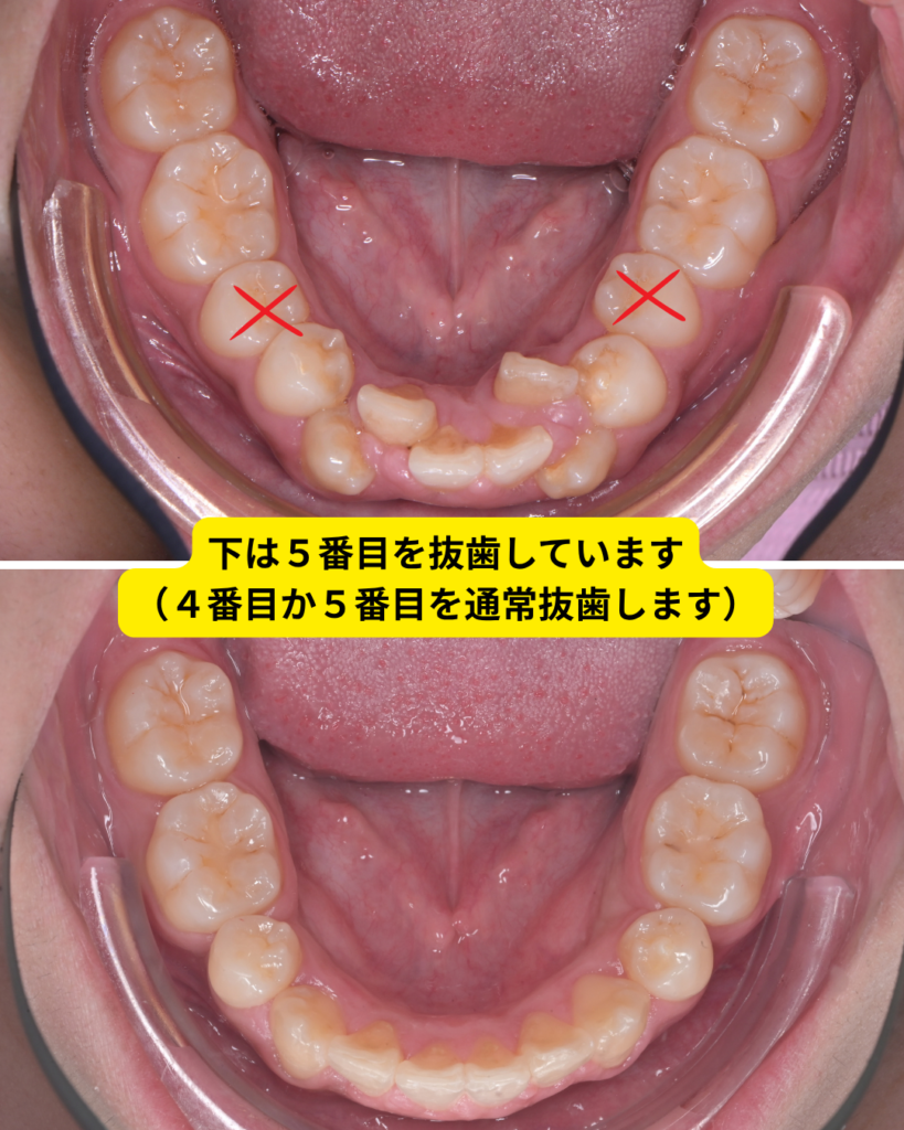 八重歯のマウスピース矯正ビフォーアフター