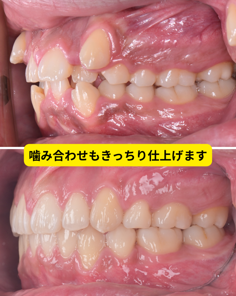 八重歯の治療前後