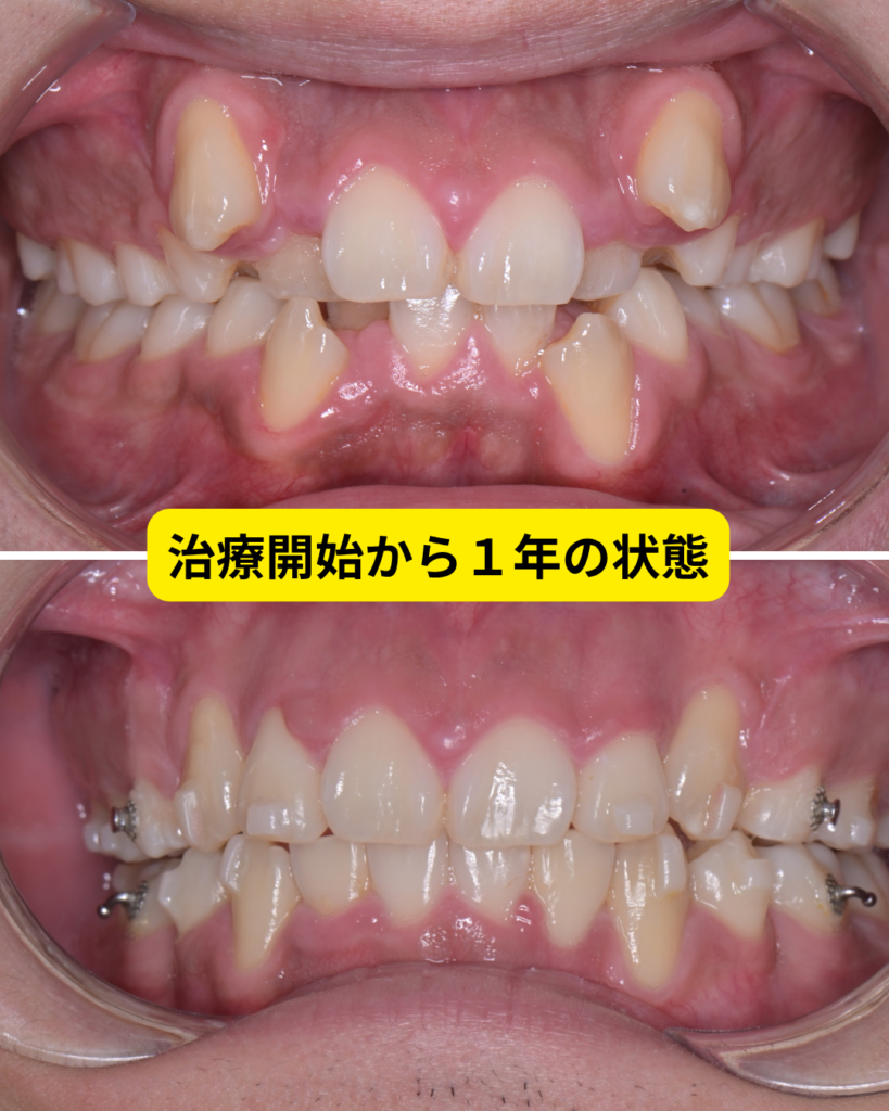 八重歯のマウスピース矯正の治療経過1年後