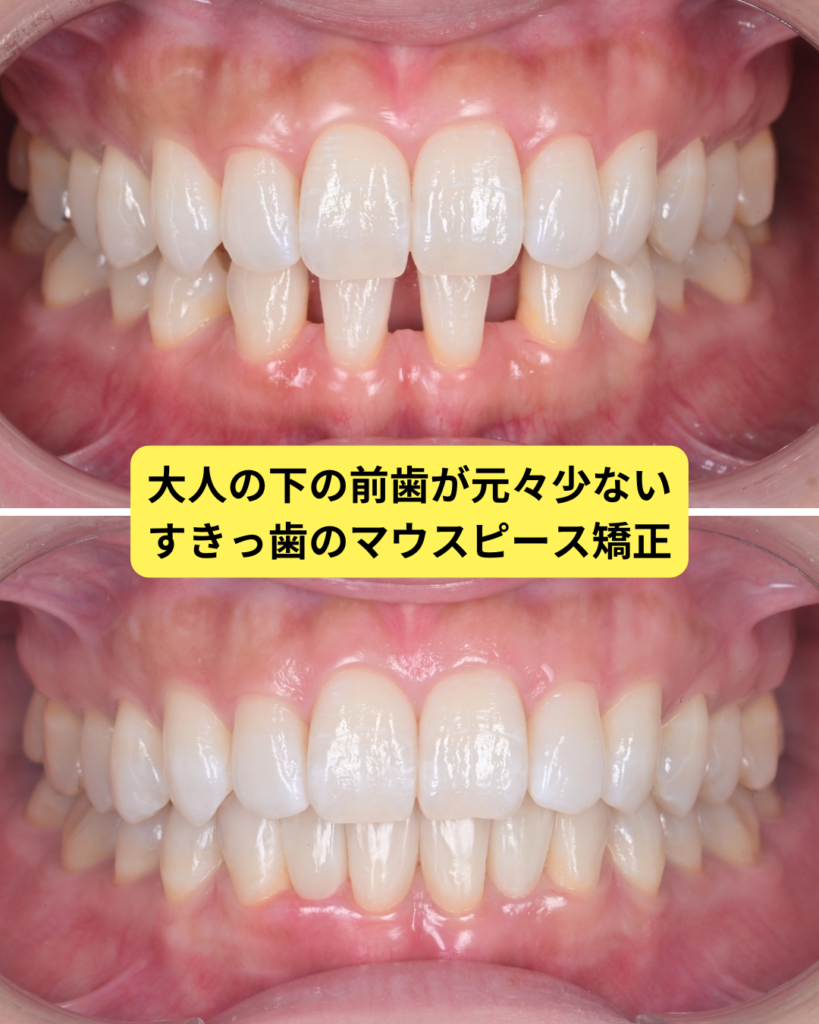 下の前歯が2本少ない先天性欠損によるすきっ歯の治療前後の口腔内写真