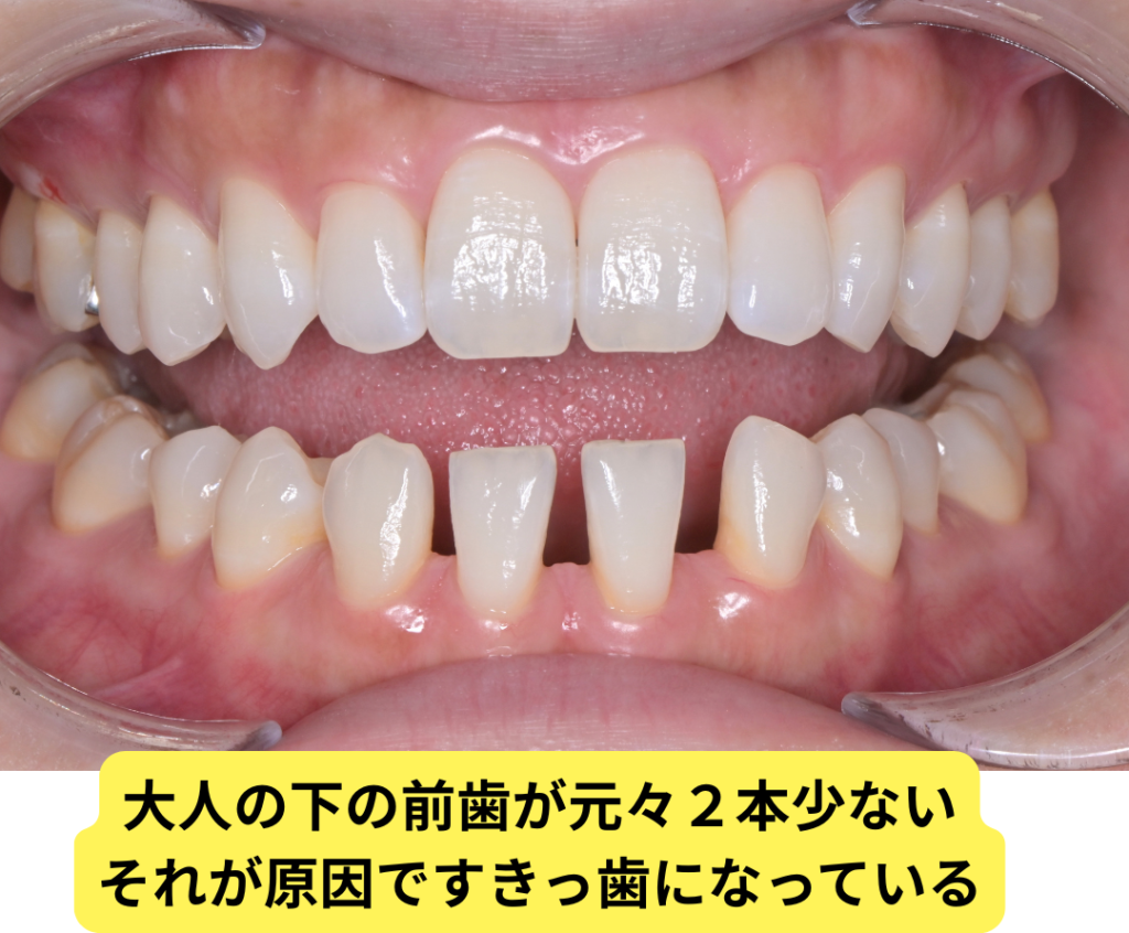 下の前歯が先天的に2本少なく、すき間が目立つ状態