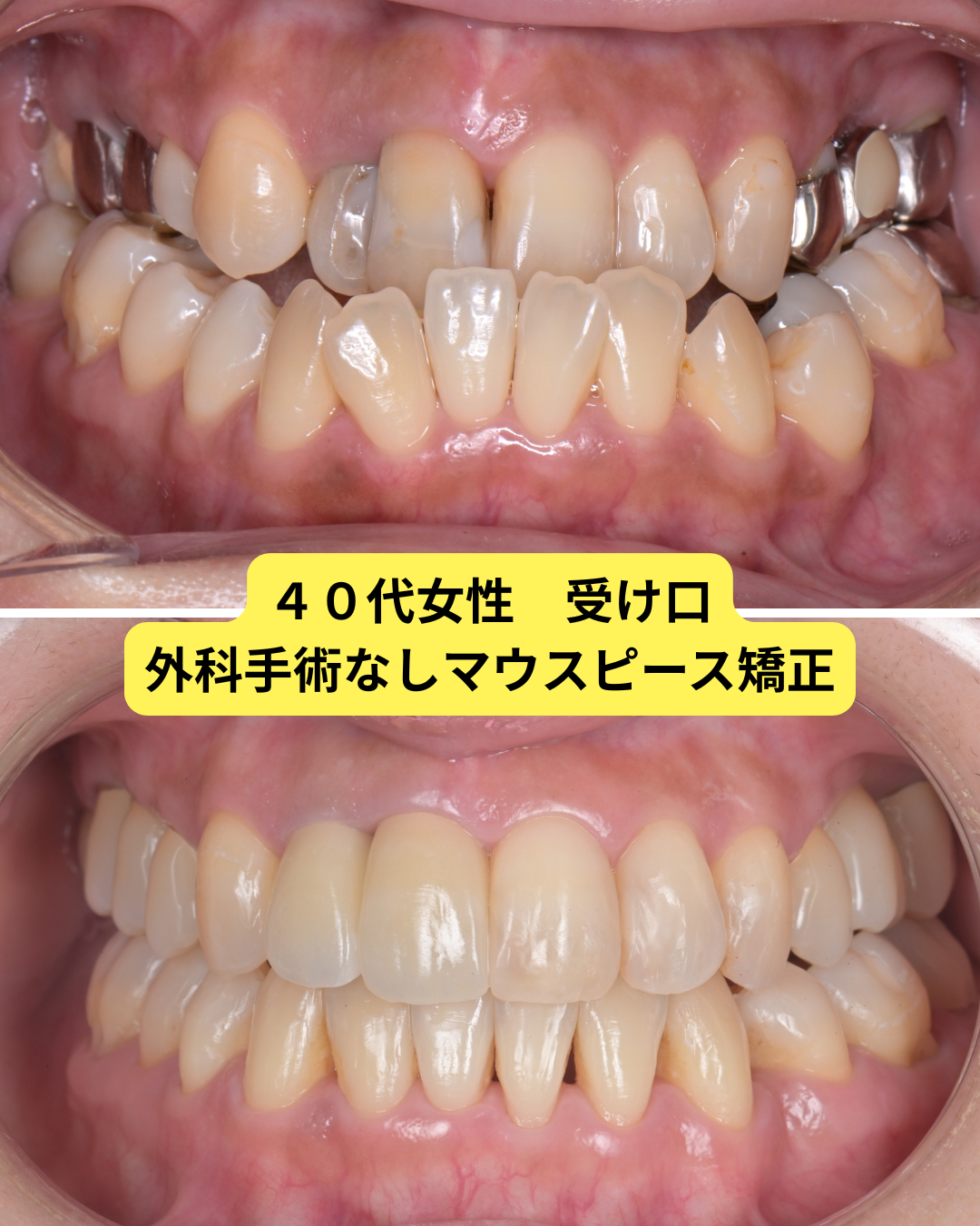 手術を勧められた受け口をマウスピース矯正で改善を目指した症例写真