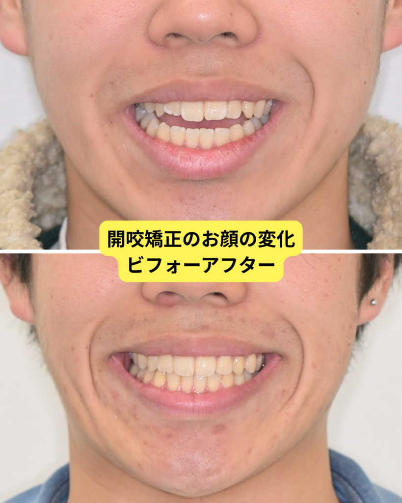 開咬矯正の顔の変化