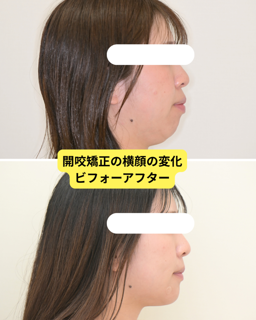 開咬矯正　Eラインの変化