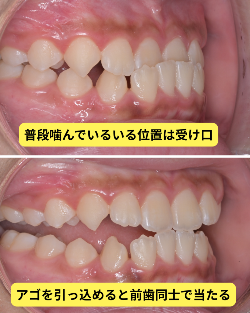 受け口　切端咬合