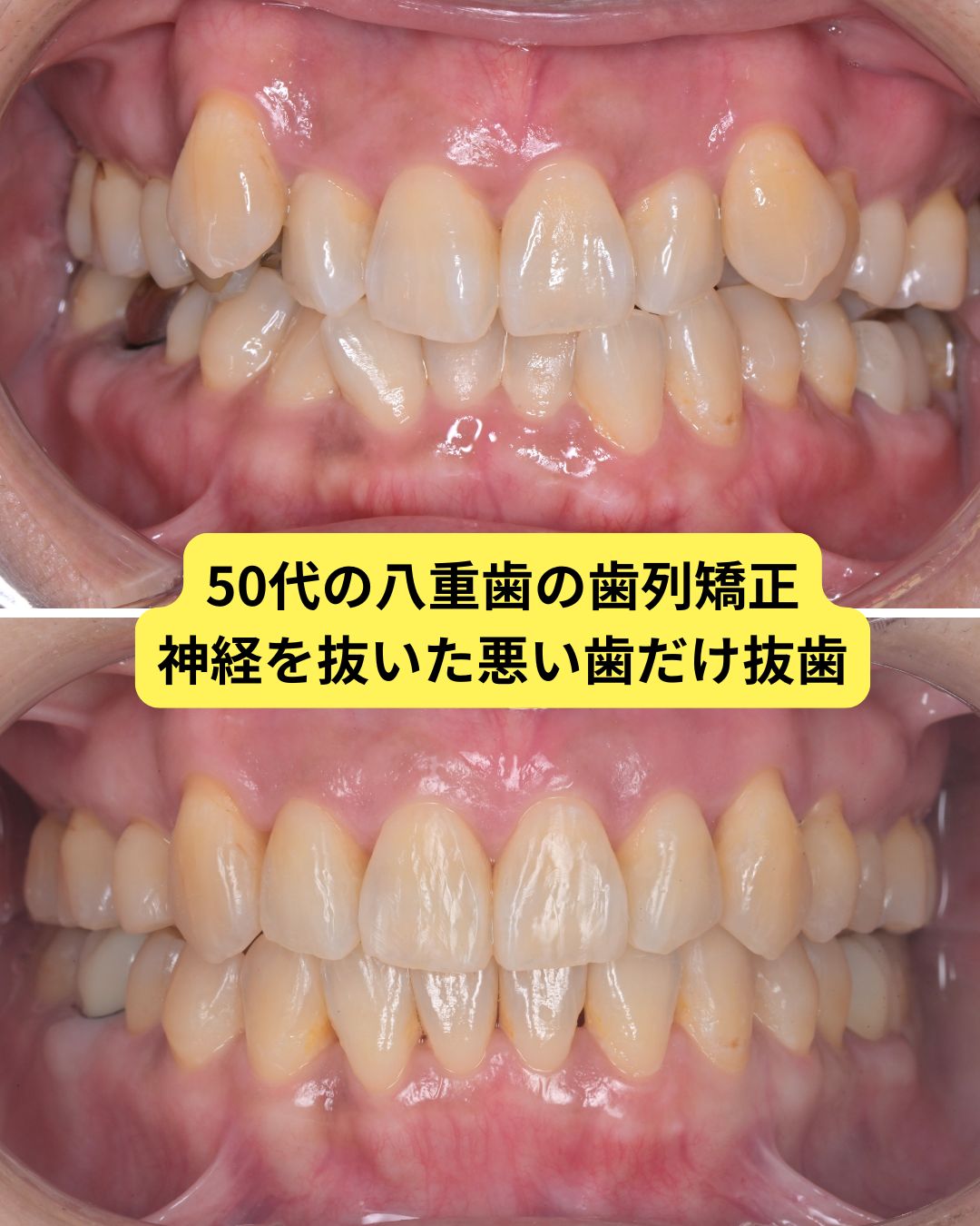 ５０代　歯列矯正　抜歯　