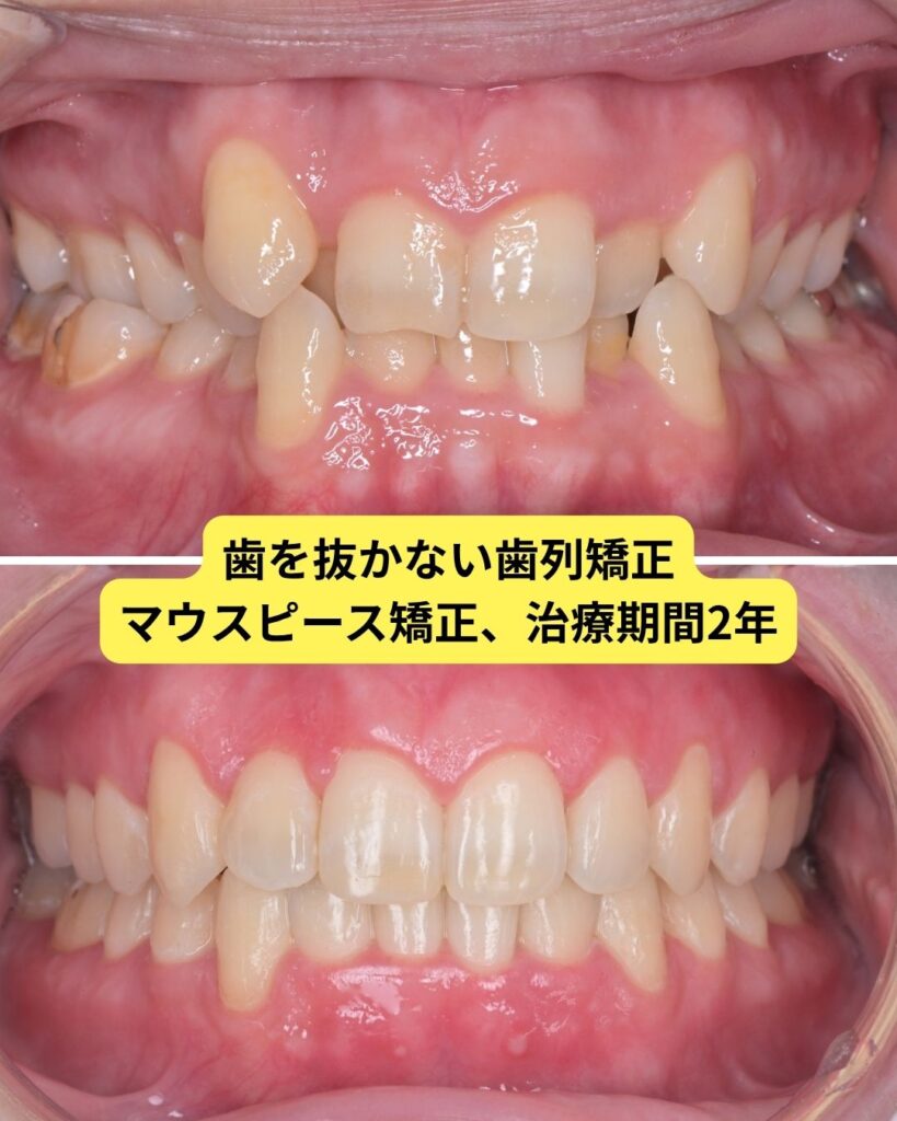 歯を抜かない矯正ビフォーアフター
