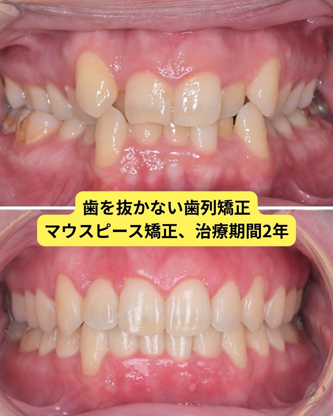 歯を抜かない非抜歯矯正ビフォーアフター