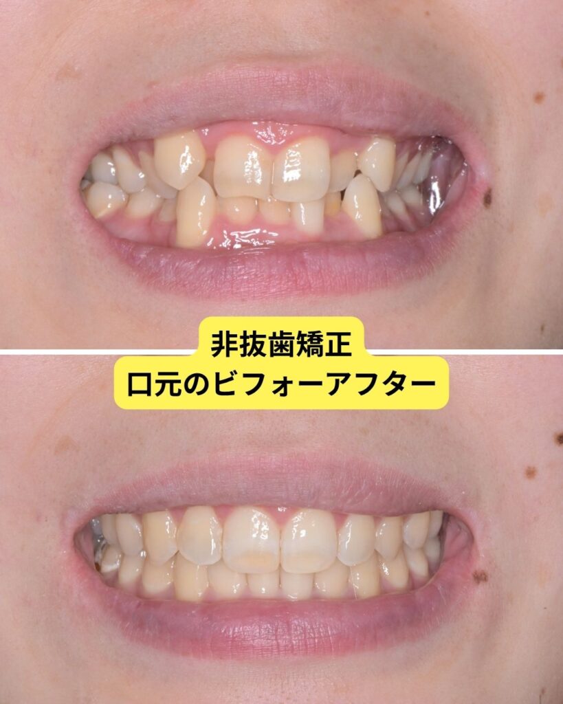 歯を抜かない矯正 顔の変化