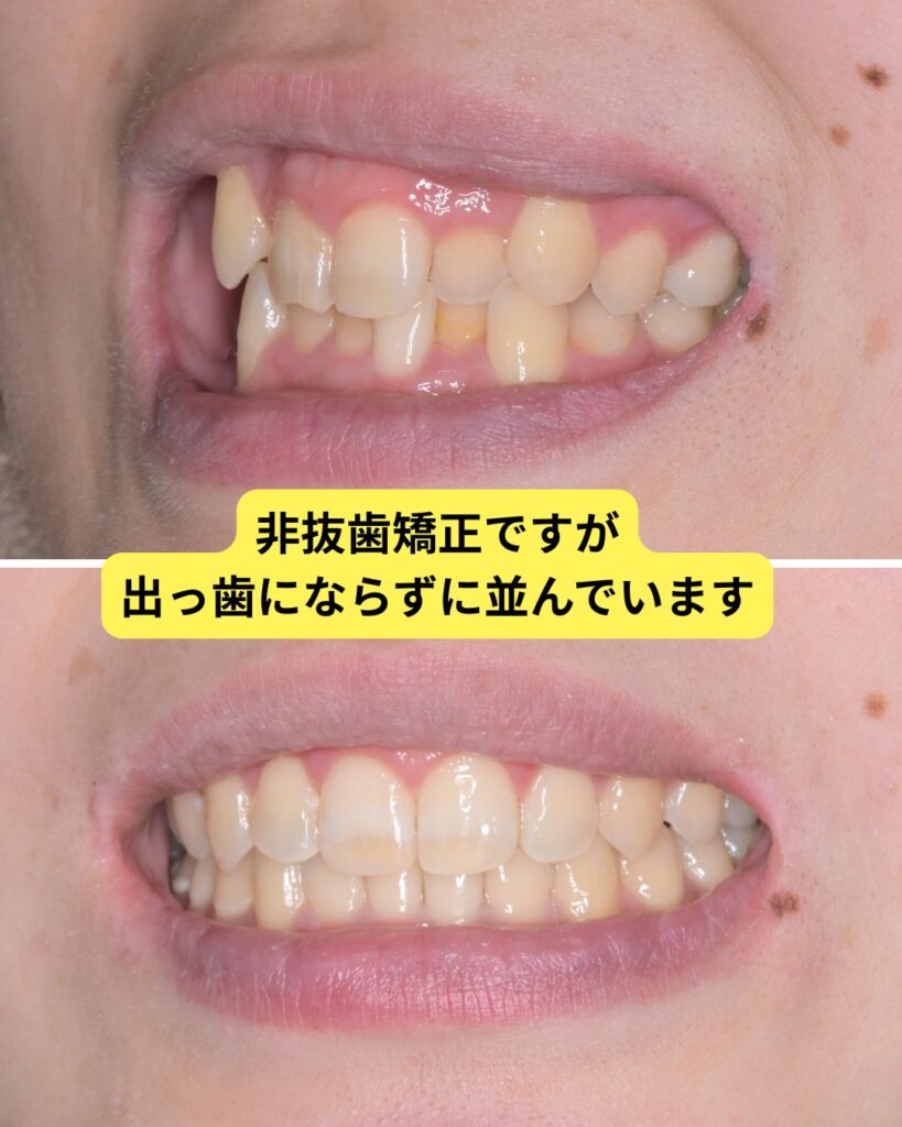 非抜歯矯正 口元の変化