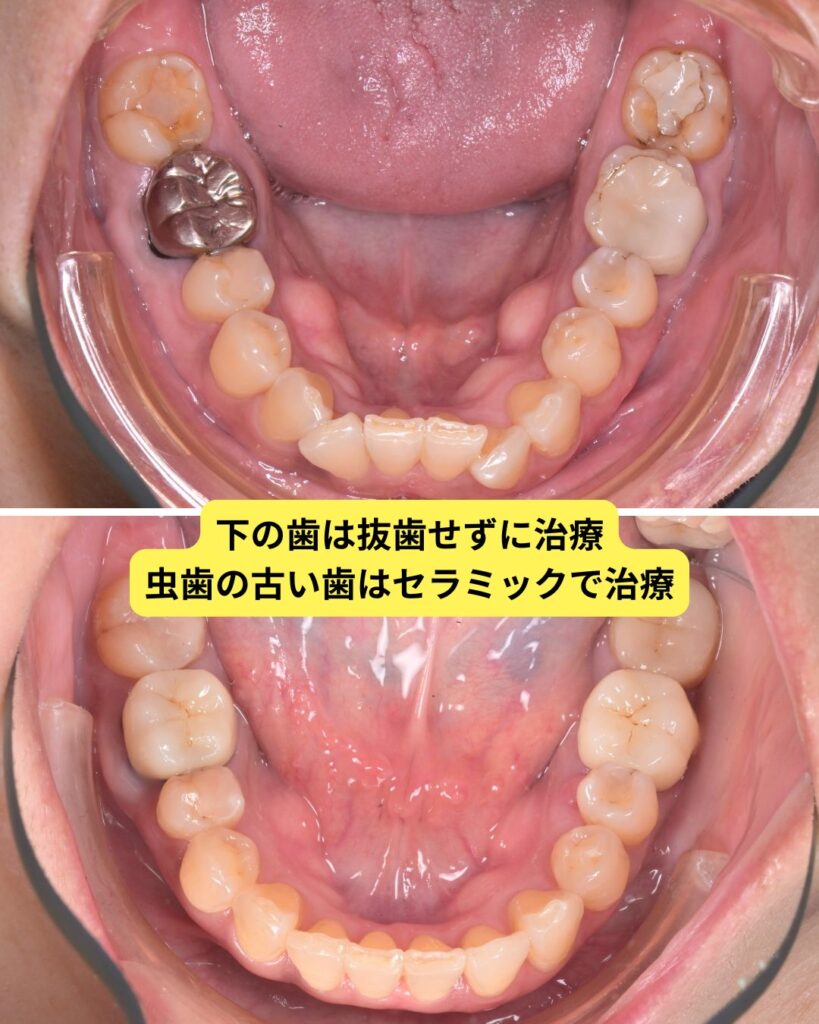 ５０代　歯列矯正　セラミック治療を併用