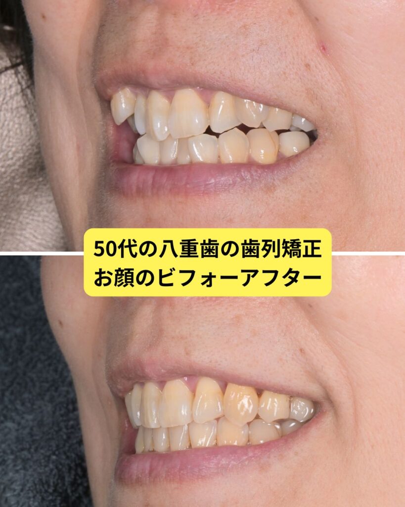 ５０代　歯列矯正　抜歯　お顔の変化