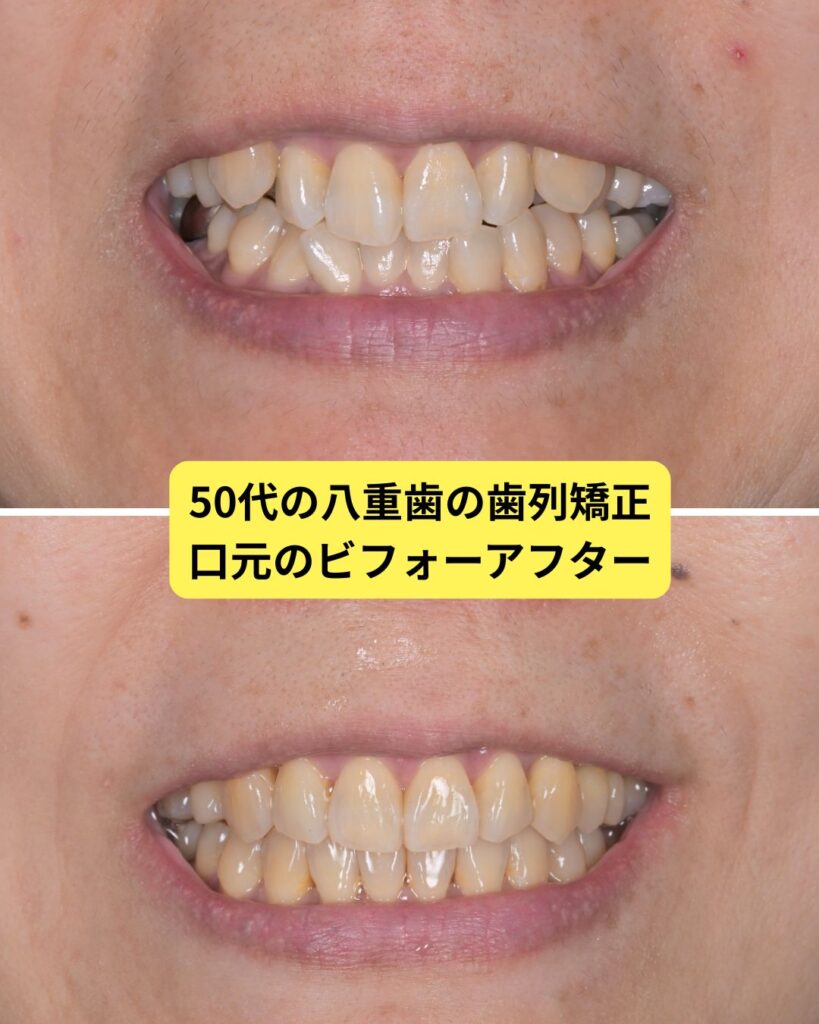 ５０代　歯列矯正　抜歯　お顔の変化