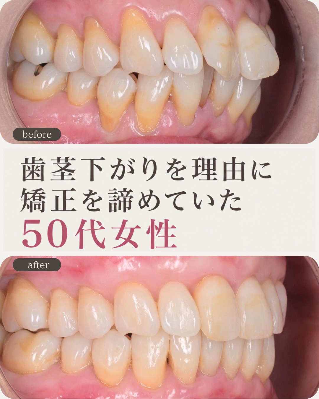 歯茎下がりでも矯正できる？ 50代女性｜歯肉移植＋マウスピース矯正