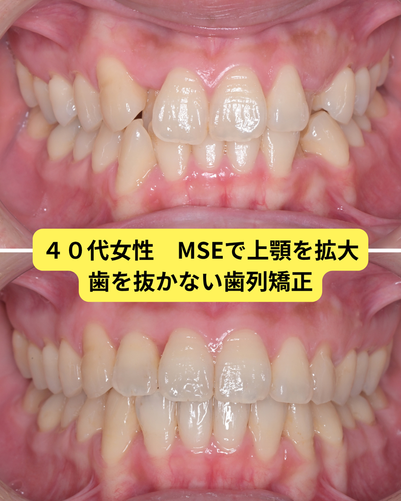 MSE 矯正