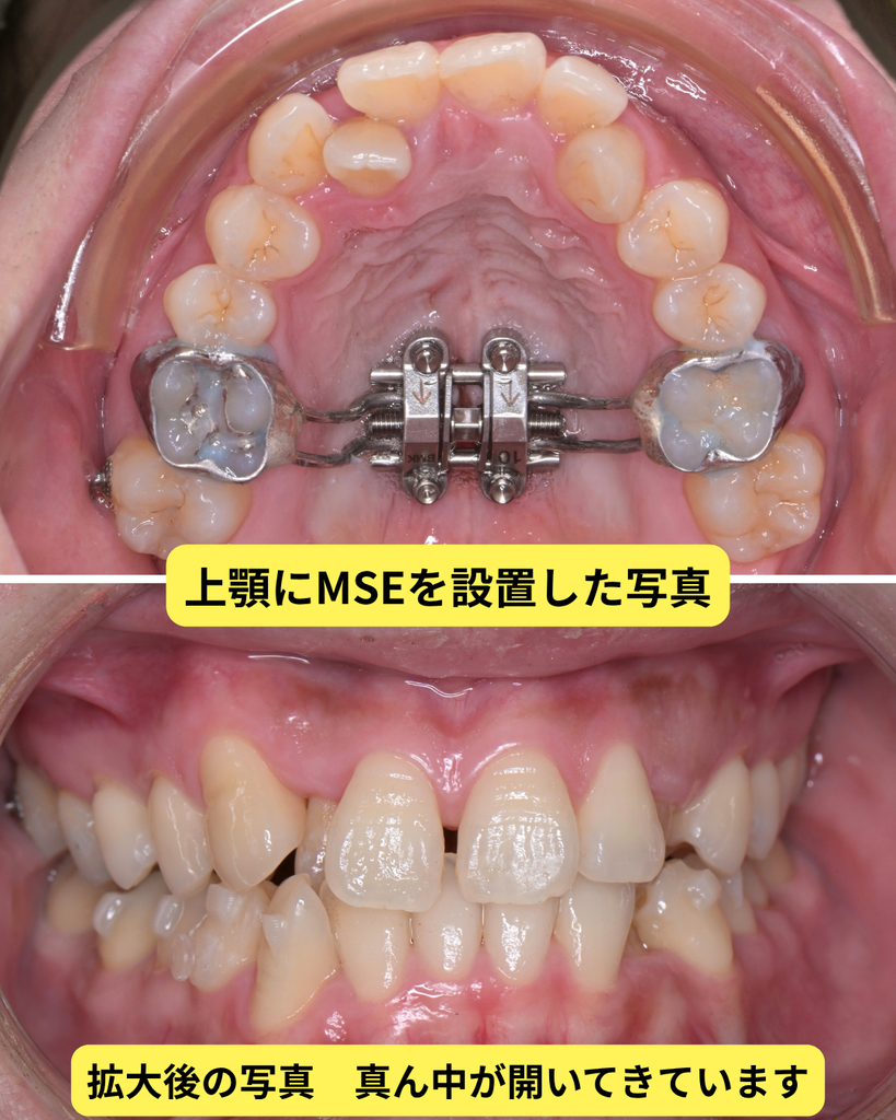 MSE 矯正