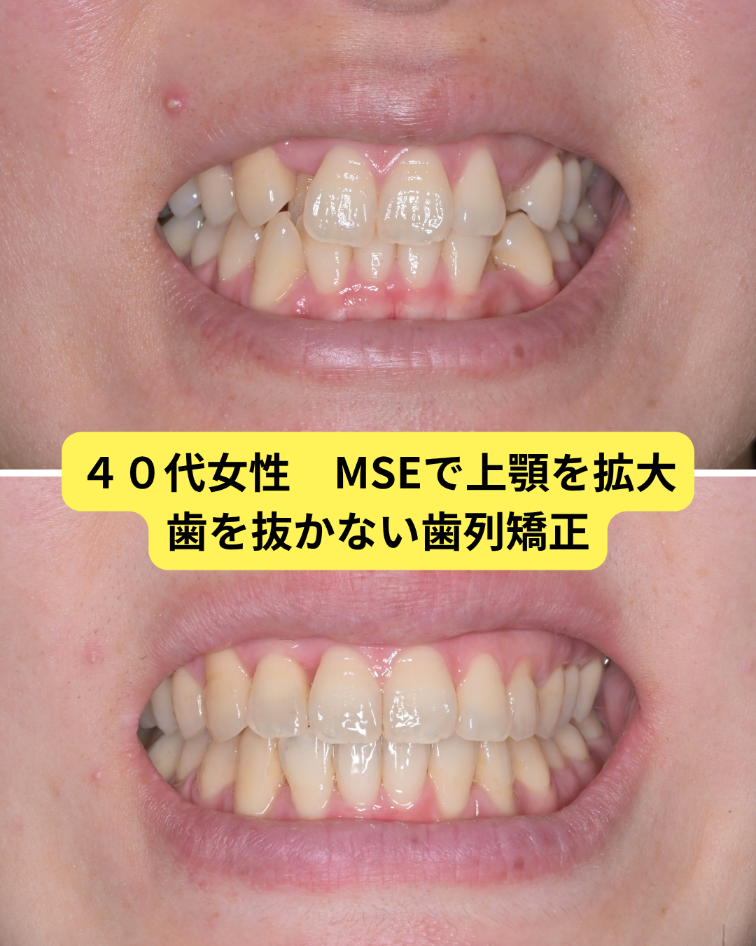 MSE 矯正