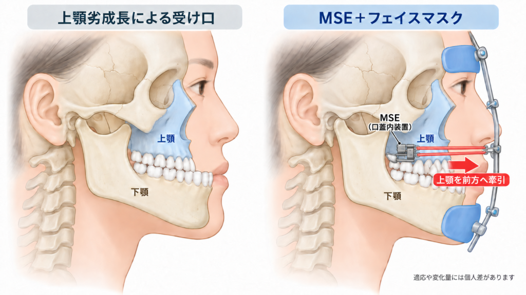 受け口の矯正 MSEとフェイスマスクの併用